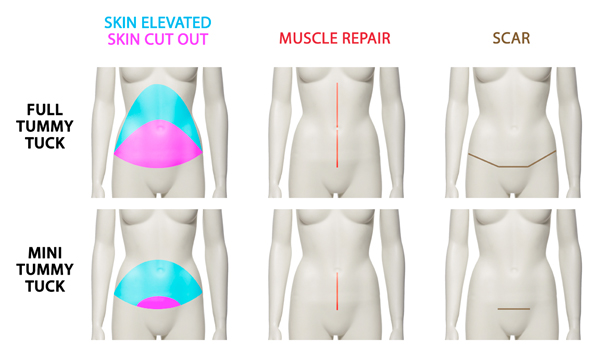 What's the difference between mini tummy tuck (mini-abdominoplasty) & tummy  tuck? Abdominoplasty 