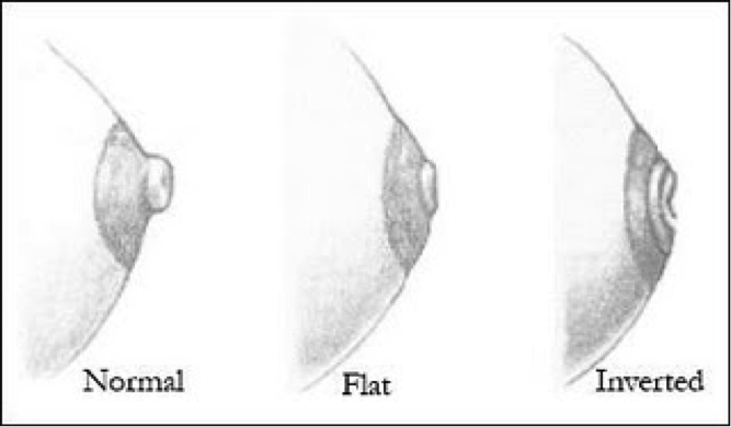 Inverted nipples: How common are they? by Dr. Shortt