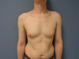 Skinny, but large man boobs : r/loseit