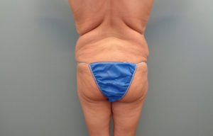 Patient #6102 Buttock Lift/Augmentation Before and After Photos