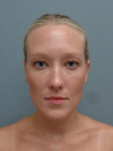 Otoplasty Before and After Pictures Nashville, TN