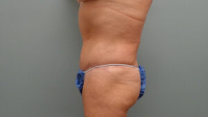 Tummy Tuck Before and After Pictures Nashville, TN