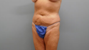 Tummy Tuck Before and After Pictures Nashville, TN