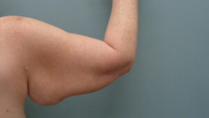 Arm Lift Before & After Pictures Nashville, TN