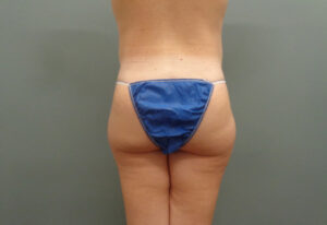 Butt Augmentation Before and After Pictures Nashville, TN