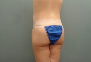 Butt Augmentation Before and After Pictures Nashville, TN