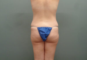 Butt Augmentation Before and After Pictures Nashville, TN