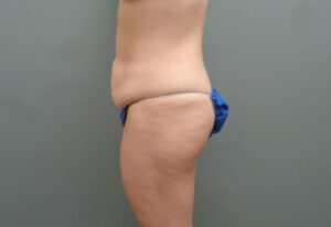 Butt Augmentation Before and After Pictures Nashville, TN