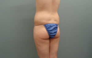 Butt Augmentation Before And After Pictures Nashville, TN