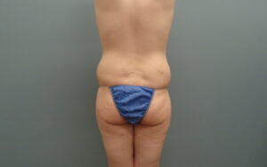 Butt Augmentation Before And After Pictures Nashville, TN