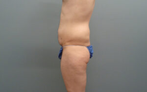 Butt Augmentation Before And After Pictures Nashville, TN