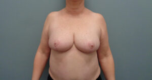 Breast Reduction Before & After Pictures in Nashville, TN