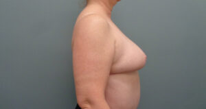 Breast Reduction Before & After Pictures in Nashville, TN