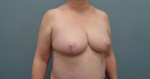 Breast Reduction Before & After Pictures in Nashville, TN