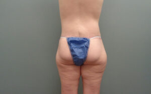 Butt Augmentation Before and After Pictures Nashville, TN