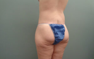 Butt Augmentation Before and After Pictures Nashville, TN