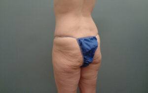 Butt Augmentation Before and After Pictures Nashville, TN