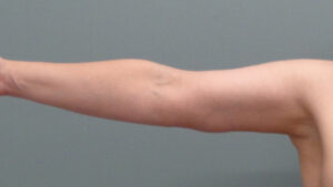 Arm Lift Before & After Pictures Nashville, TN