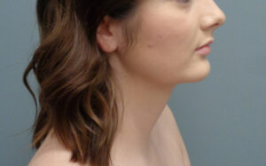 Chin Augmentation Before & After Pictures Nashville, TN