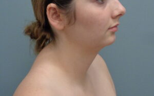 Chin Augmentation Before & After Pictures Nashville, TN